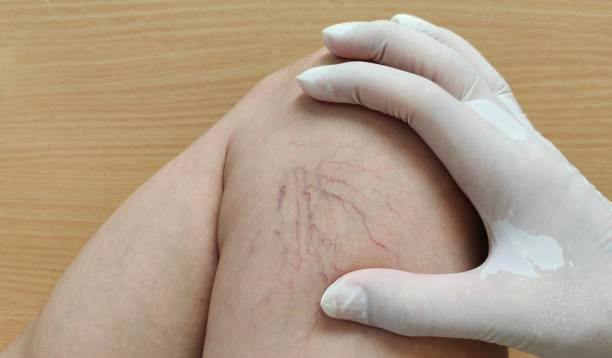 Escleroterapia de vasinhos em Cotia